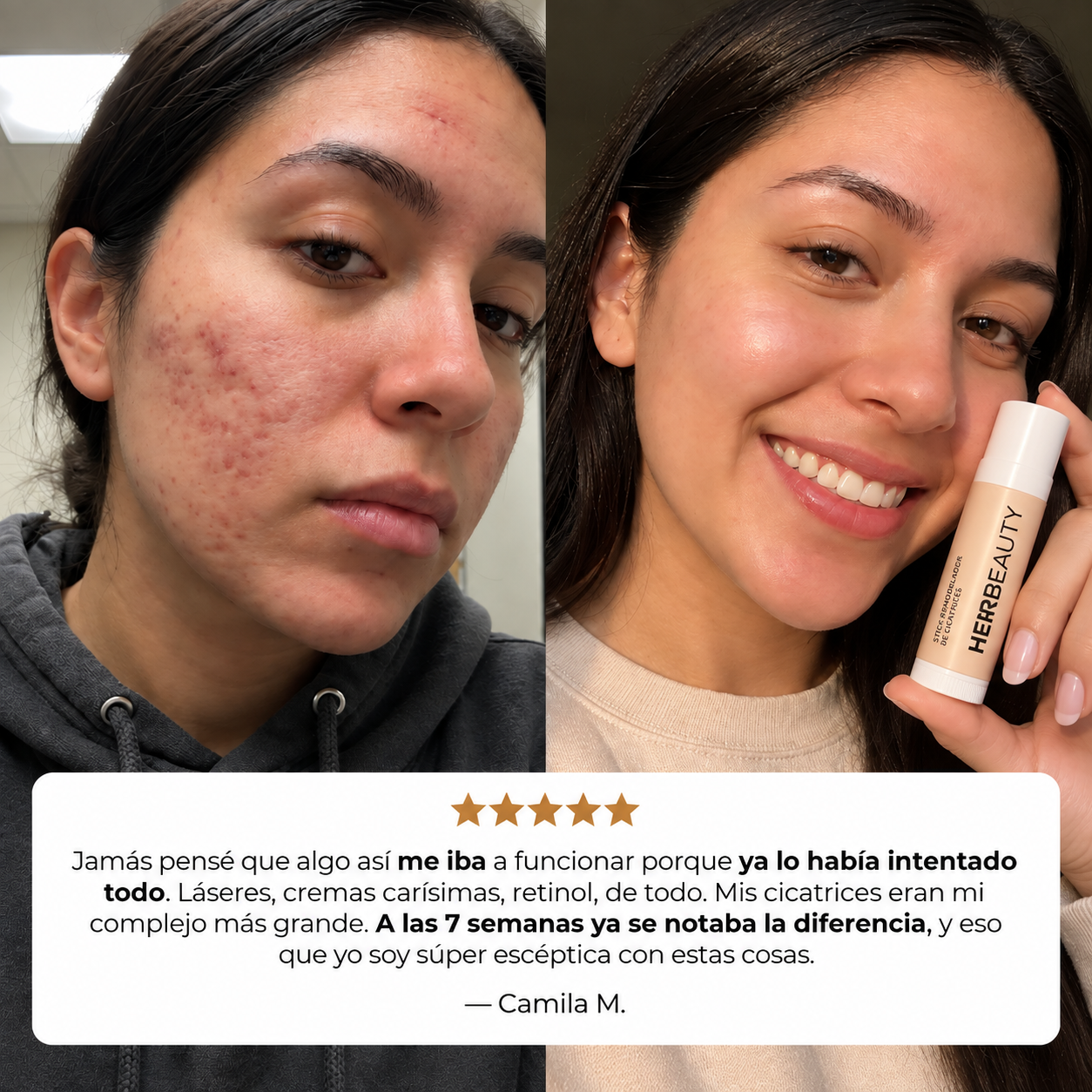 Stick Remodelador de Cicatrices de Acné™